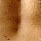 Hyperpigmentation in pregnancy: Darkening of freckles, scars, nipples, genitals, thighs and arm pits
