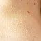Cancer-killing cream for melanoma