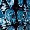 Drug shrinks brain tumors in children with tuberous sclerosis complex