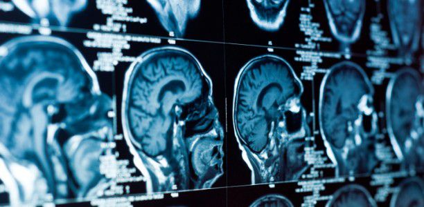 Drug shrinks brain tumors in children with tuberous sclerosis complex