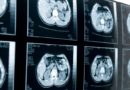 Brain imaging identifies bipolar disorder risk in adolescents