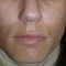 Mask of Pregnancy – Melasma