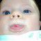 ‘Strawberry’ birthmarks grow rapidly when babies just weeks old