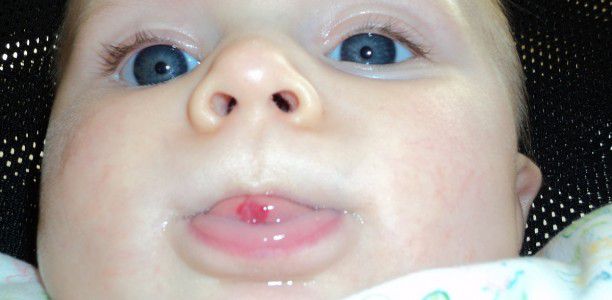 ‘Strawberry’ birthmarks grow rapidly when babies just weeks old