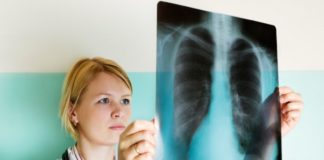 Doctor looking at lung x-ray