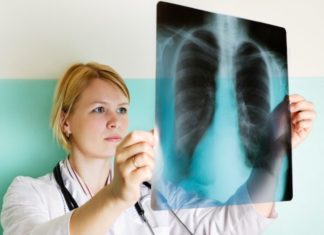 Doctor looking at lung x-ray