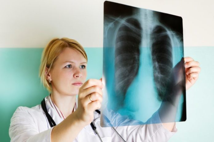 Doctor looking at lung x-ray