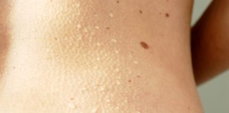 Moles on skin