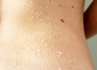 Moles on skin