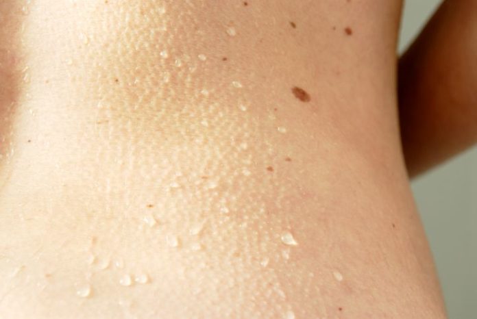 Moles on skin